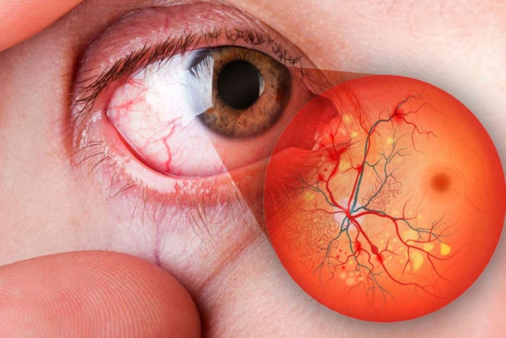 Qué es el edema macular