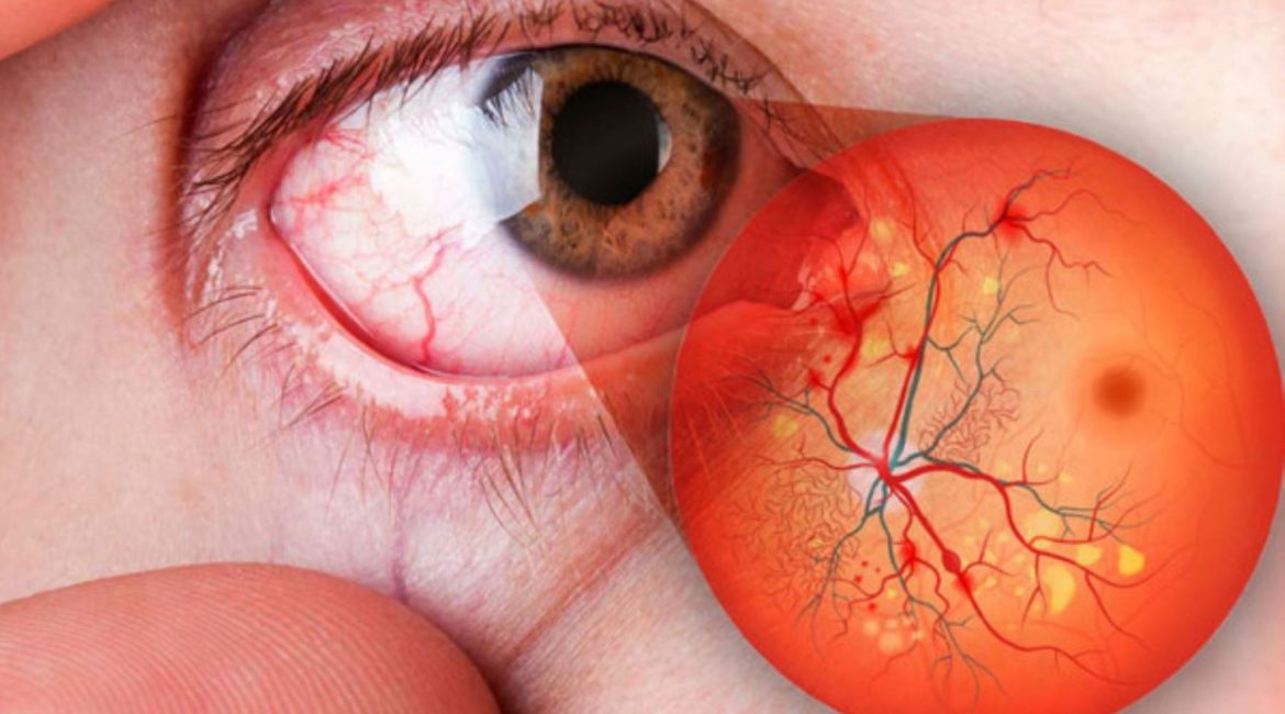 Qué es el edema macular