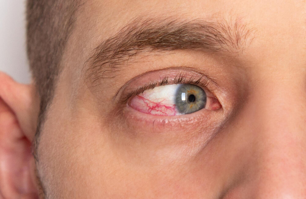 Paciente con Uveitis