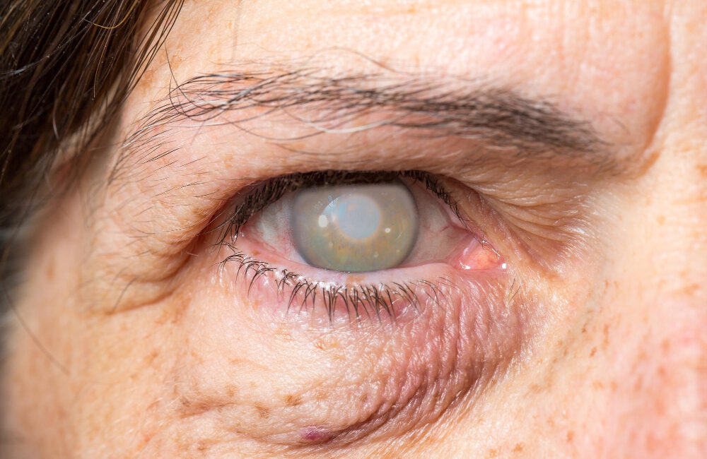 Tipos de cataratas en los ojos