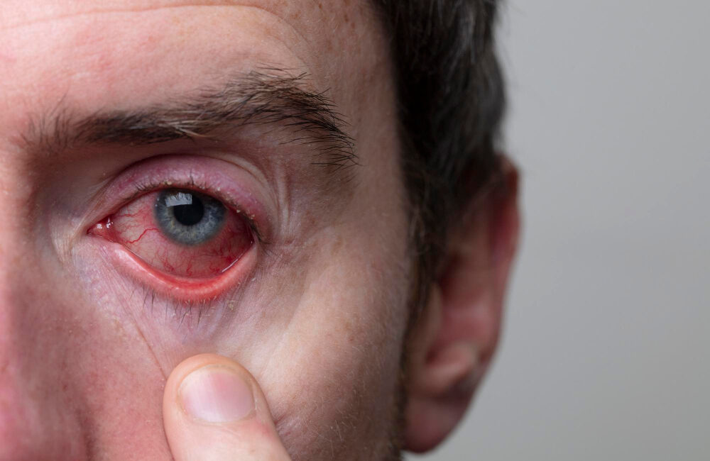 recuperar la vista después de un infarto ocular