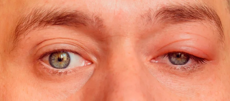 Cirugía de ptosis palpebral