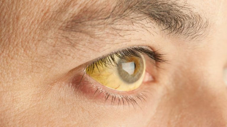 ¿Es malo tener los ojos amarillos?