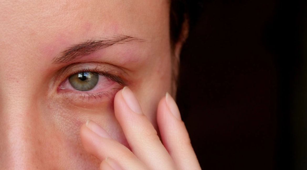 Hiperemia conjuntival