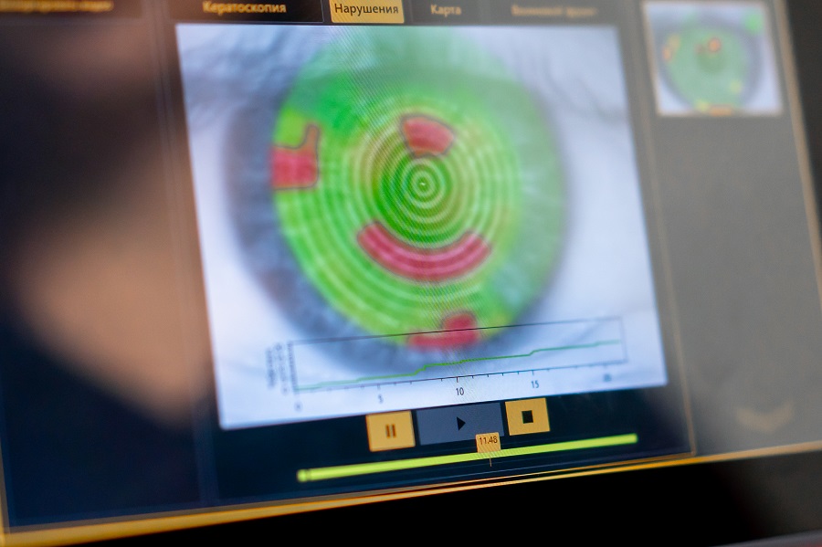 como diferenciar glaucoma, cataratas o degeneración macular