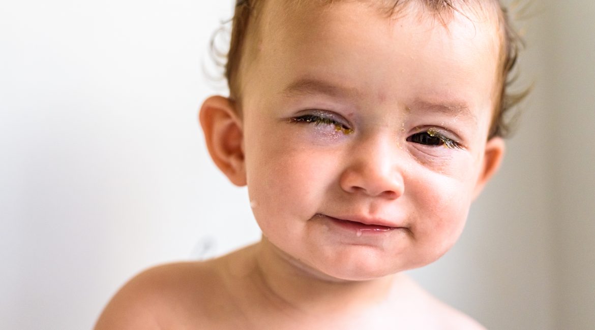 Diferencia entre conjuntivitis y mocos en los ojos de los niños