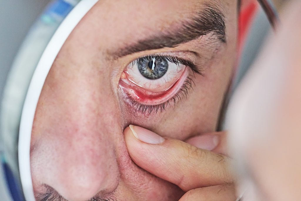 ¿Cuál es el mejor tratamiento para la conjuntivitis?
