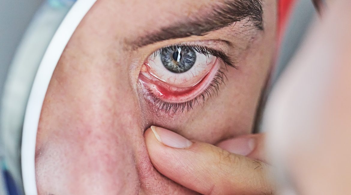 ¿Cuál es el mejor tratamiento para la conjuntivitis?