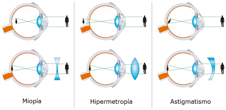 diferencias entre hipermetropia, astigmatismo y miopia