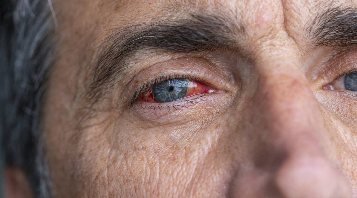 Derrame en el ojo – Causas y qué hacer para quitarlo