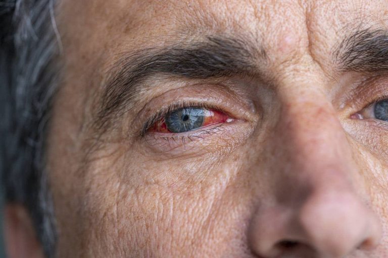 Derrame en el ojo – Causas y qué hacer para quitarlo