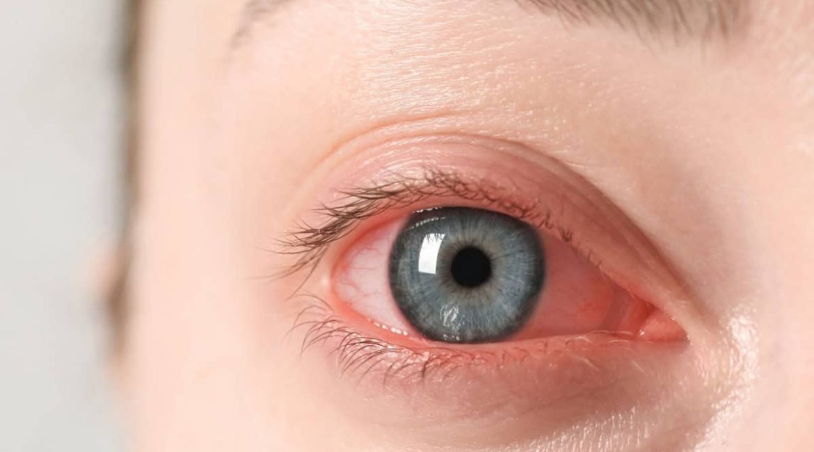 ¿Por qué se ponen los ojos rojos y cómo quitar?