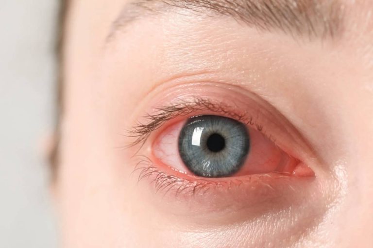 ¿Por qué se ponen los ojos rojos y cómo quitar?